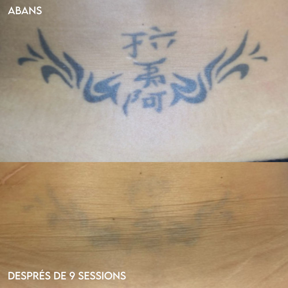 Eliminación de tatuajes láser