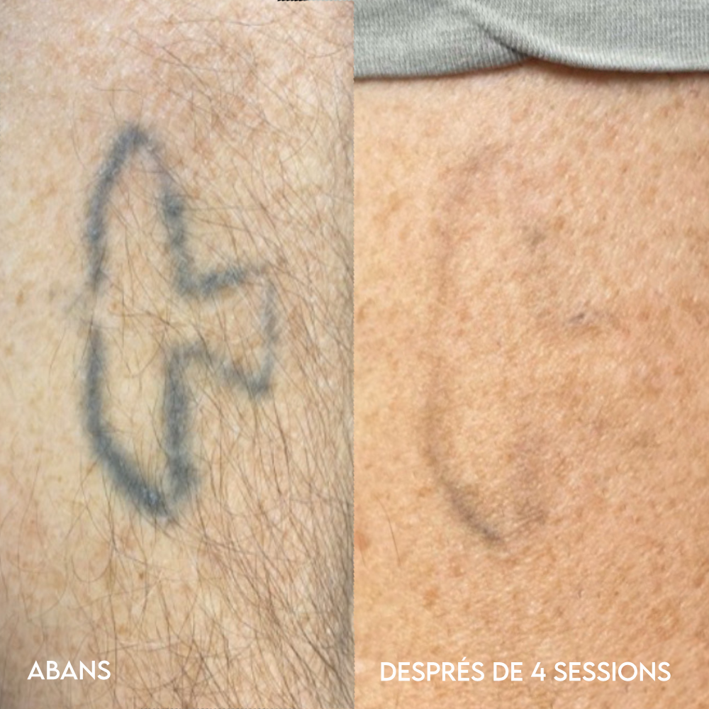Eliminación de tatuajes láser