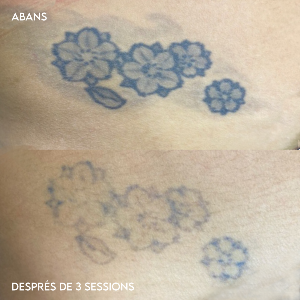 Eliminación de tatuajes láser