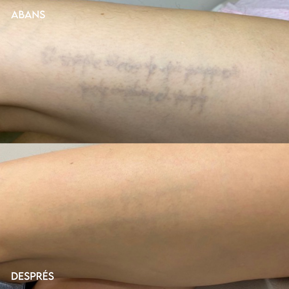 Eliminación de tatuajes láser