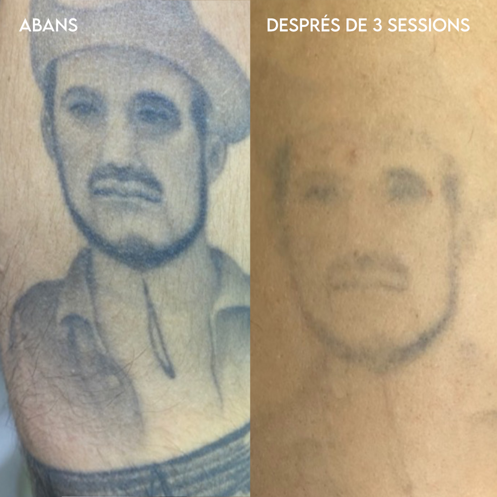 Eliminación de tatuajes láser