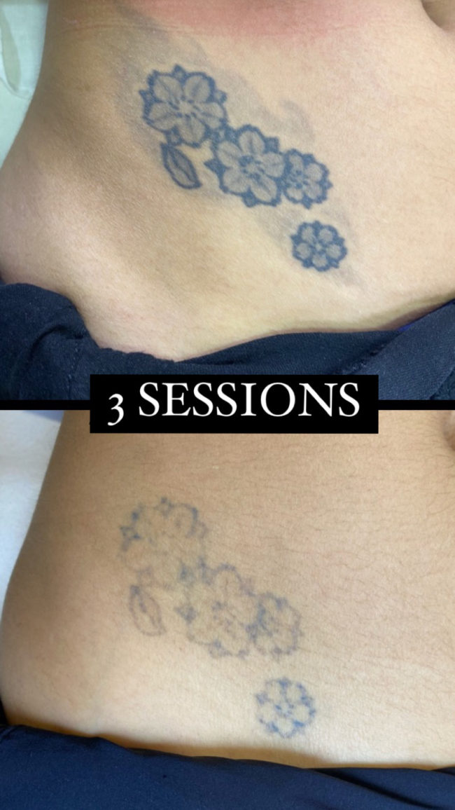 Resultat de l'eliminació amb làser de tatuatges de flors a Sabadell, Barcelona