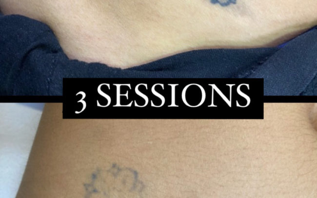 resultat del laser tattoo després d'unes sessions