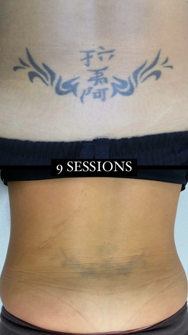 Eliminació de tatuatges a Sabadell amb Mökki Tattoo Studio. Imatge d'un tattoo eliminat