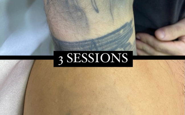 resultat del laser tattoo després d'unes sessions