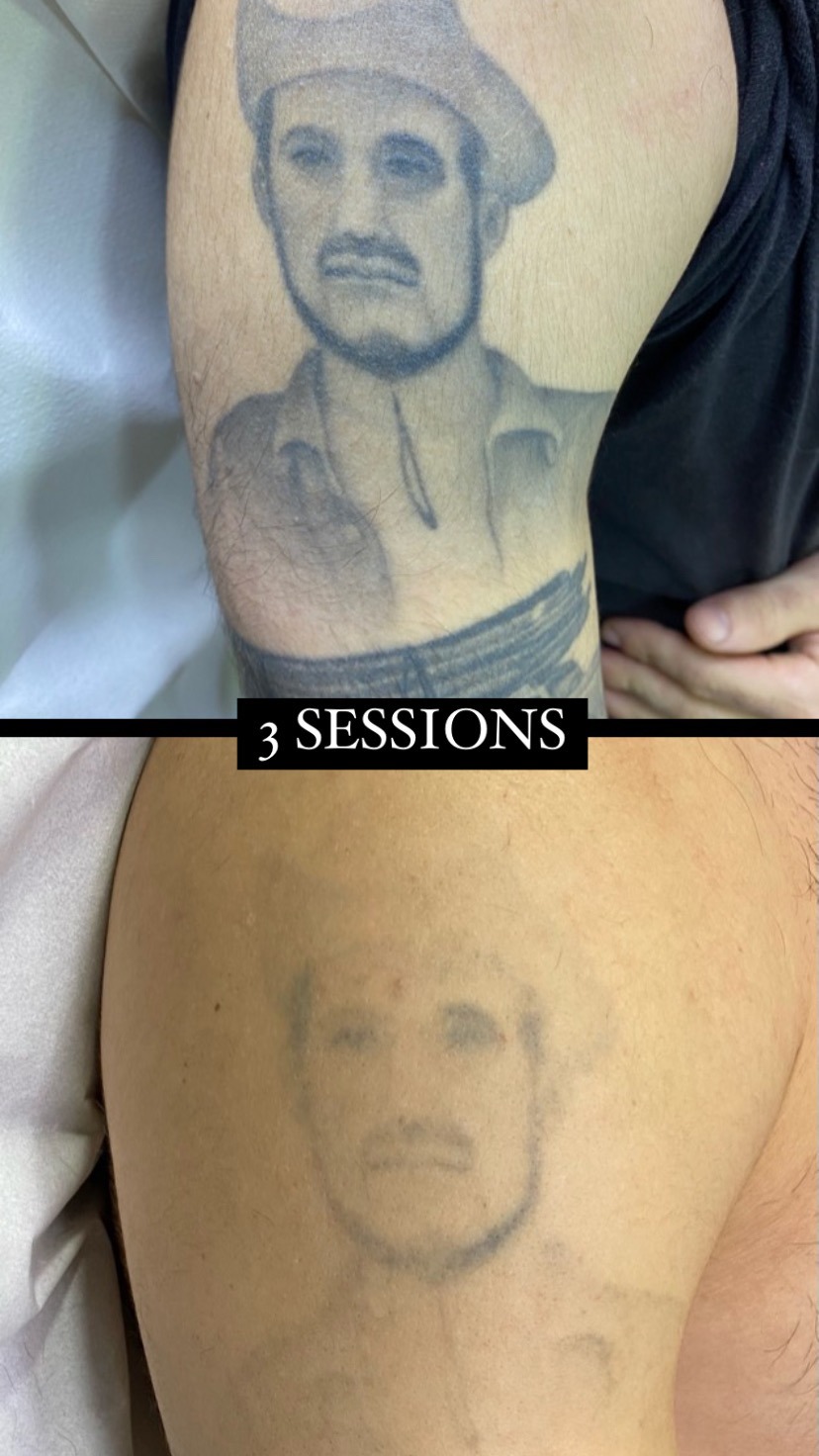 resultat del laser tattoo després d'unes sessions