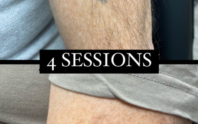 resultat del laser tattoo després d'unes sessions