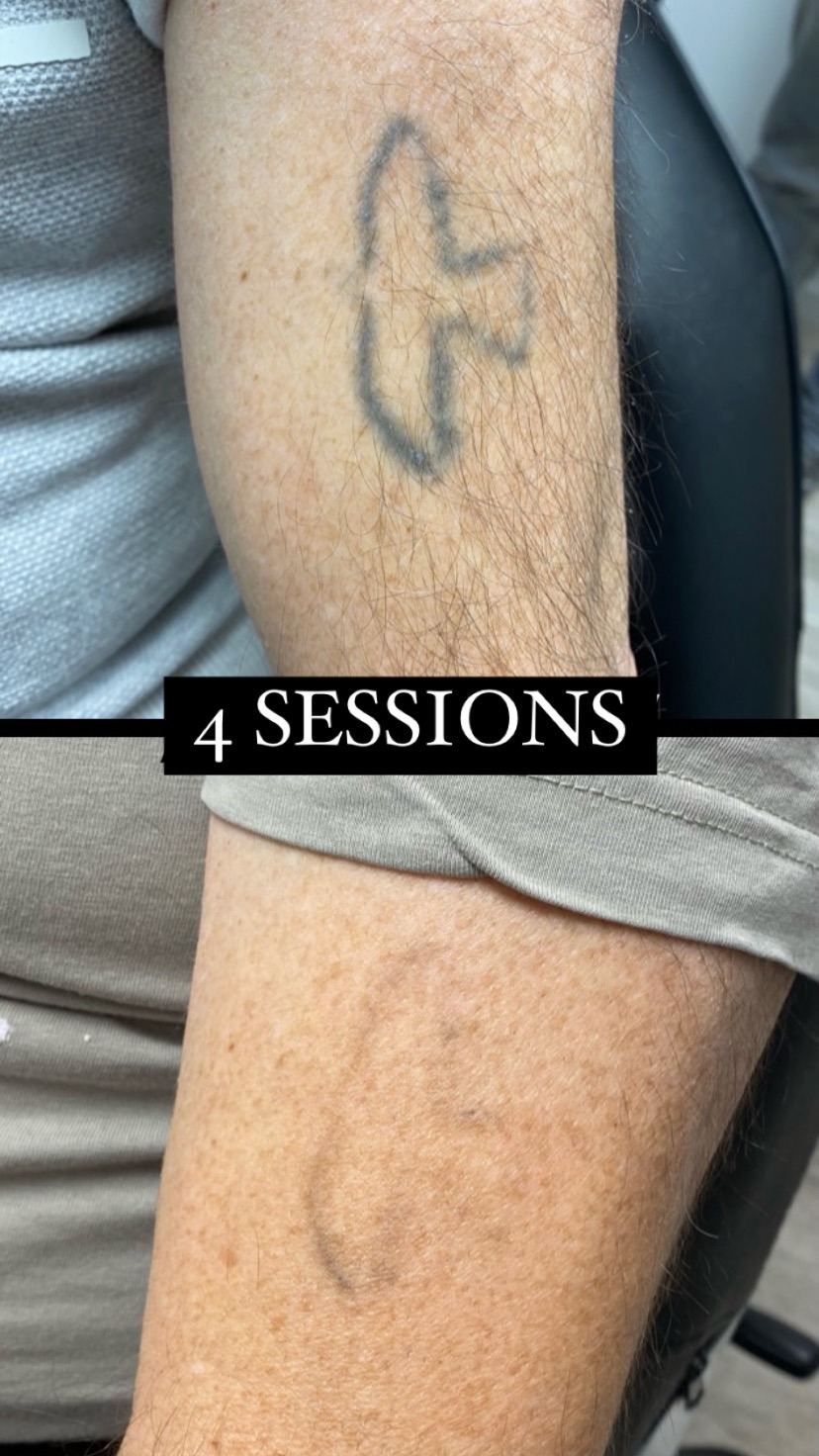 resultat del laser tattoo després d'unes sessions