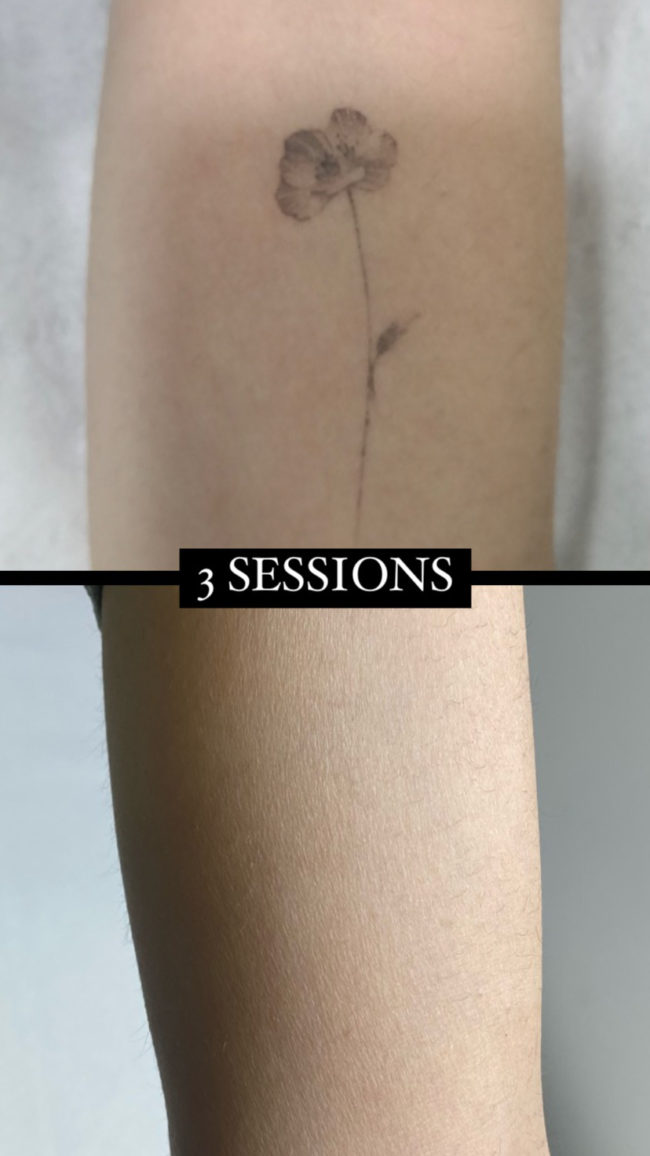 Resultat de l'eliminació amb làser del tatuatge d'una flor a Sabadell, Barcelona