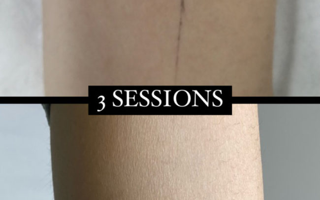 resultat del laser tattoo després d'unes sessions